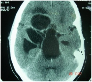 Figure-4: Multiple cysts 